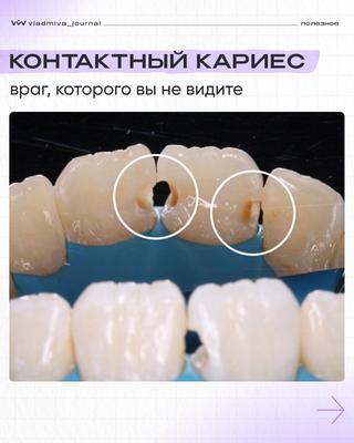 Контактный кариес — невидимый враг, которого мы видим.